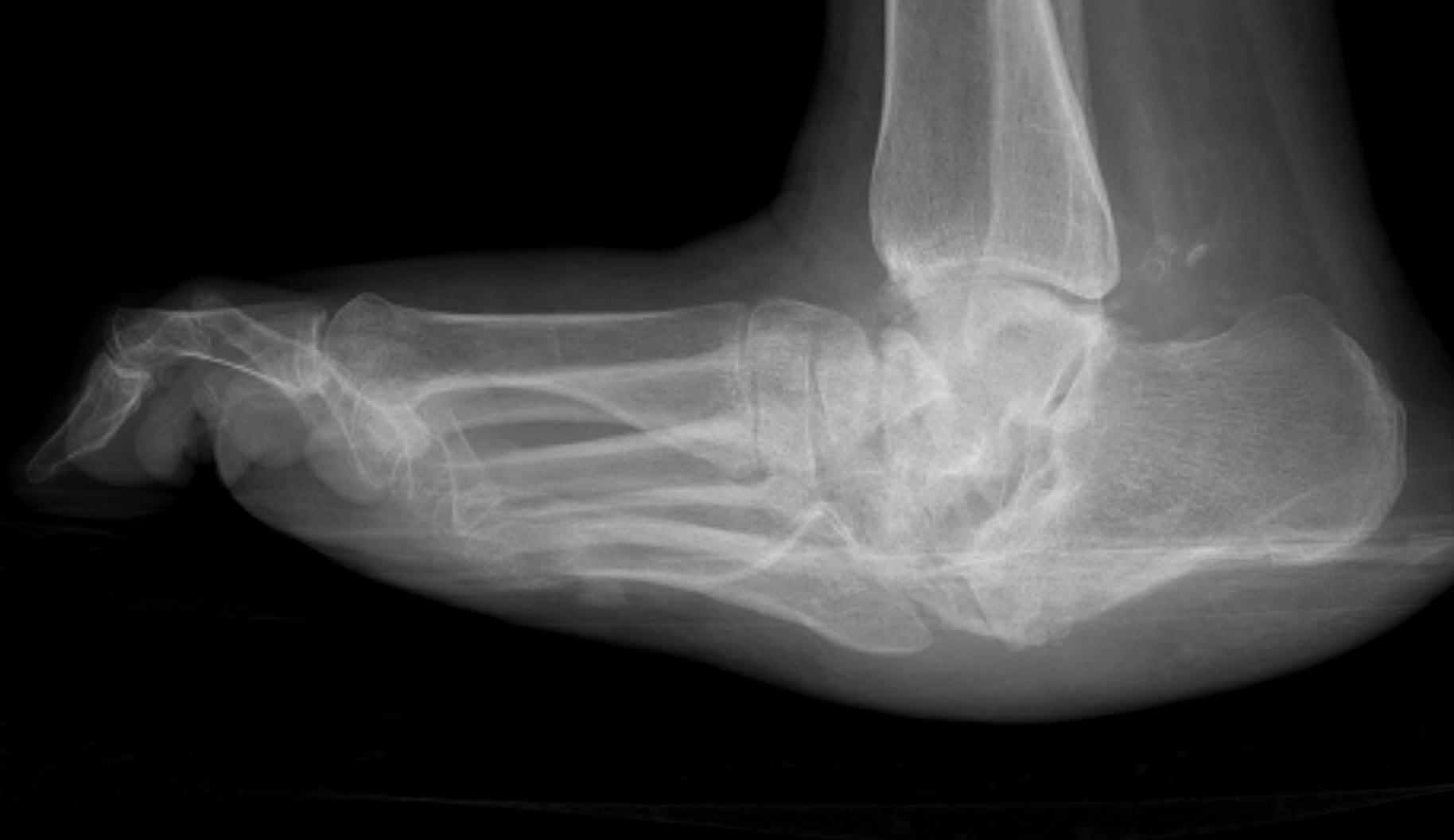 Charcot Midfoot Collapse